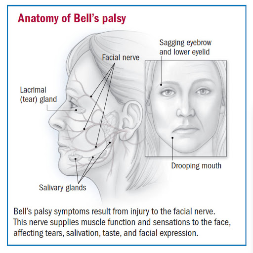Harvard Heatlh The symptoms of Bell's Palsy.
